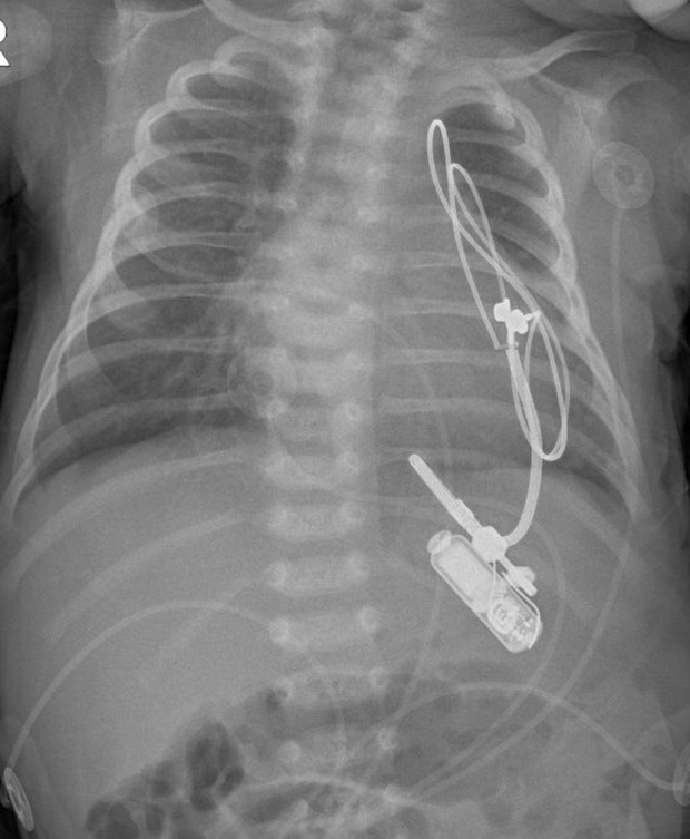 mikey-oliveri-pacemaker-credit-hassenfeld-childrens-hospital-at-nyu-langone.png 